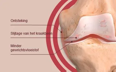 Wat is kraakbeendegeneratie of chondropathie ?